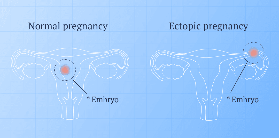image of regular pregnancy and a ectopic pregnancy